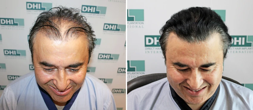 Result - 3 Years, Age 50