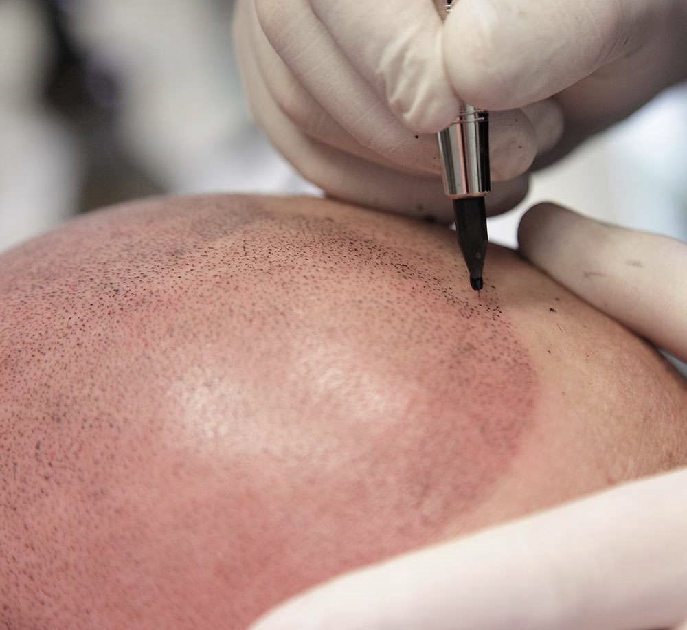micropigmentation