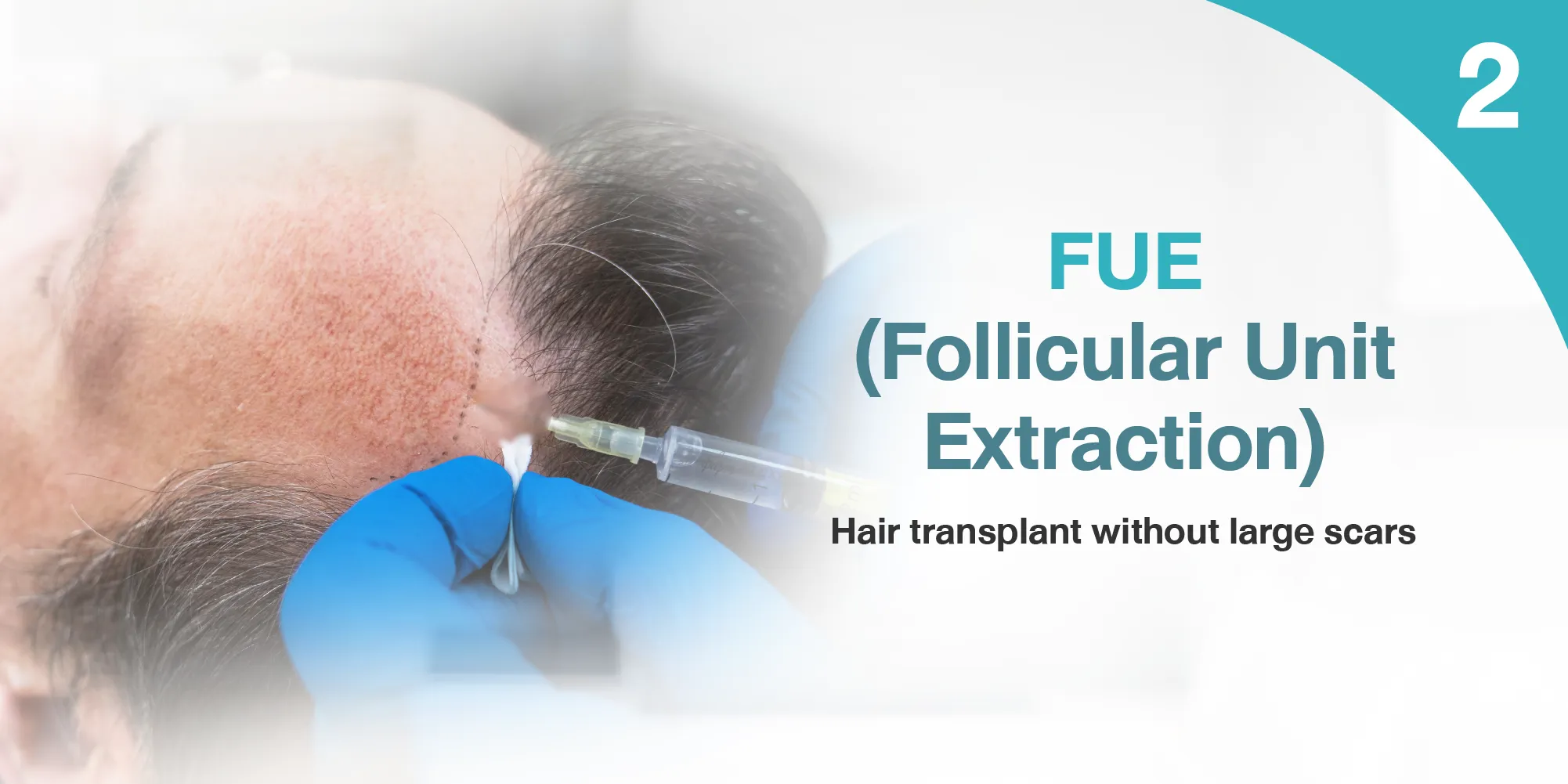 FUE (Follicular Unit Extraction)