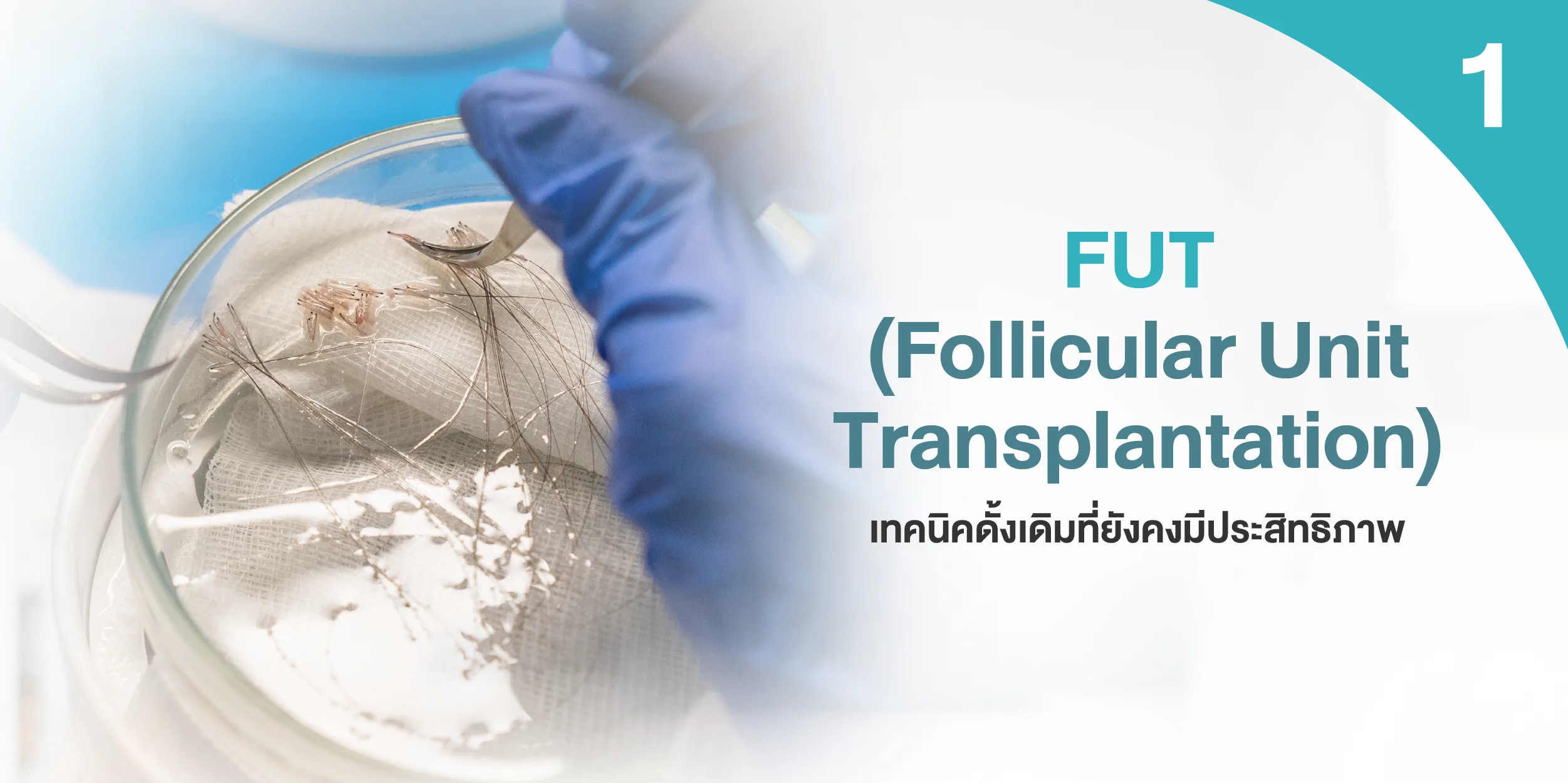 FUT (Follicular Unit Transplantation)