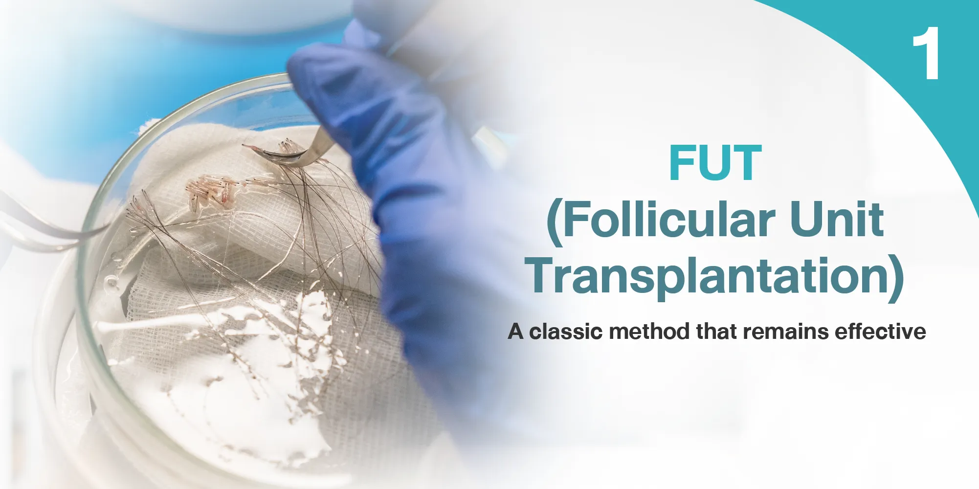 FUT (Follicular Unit Transplantation)