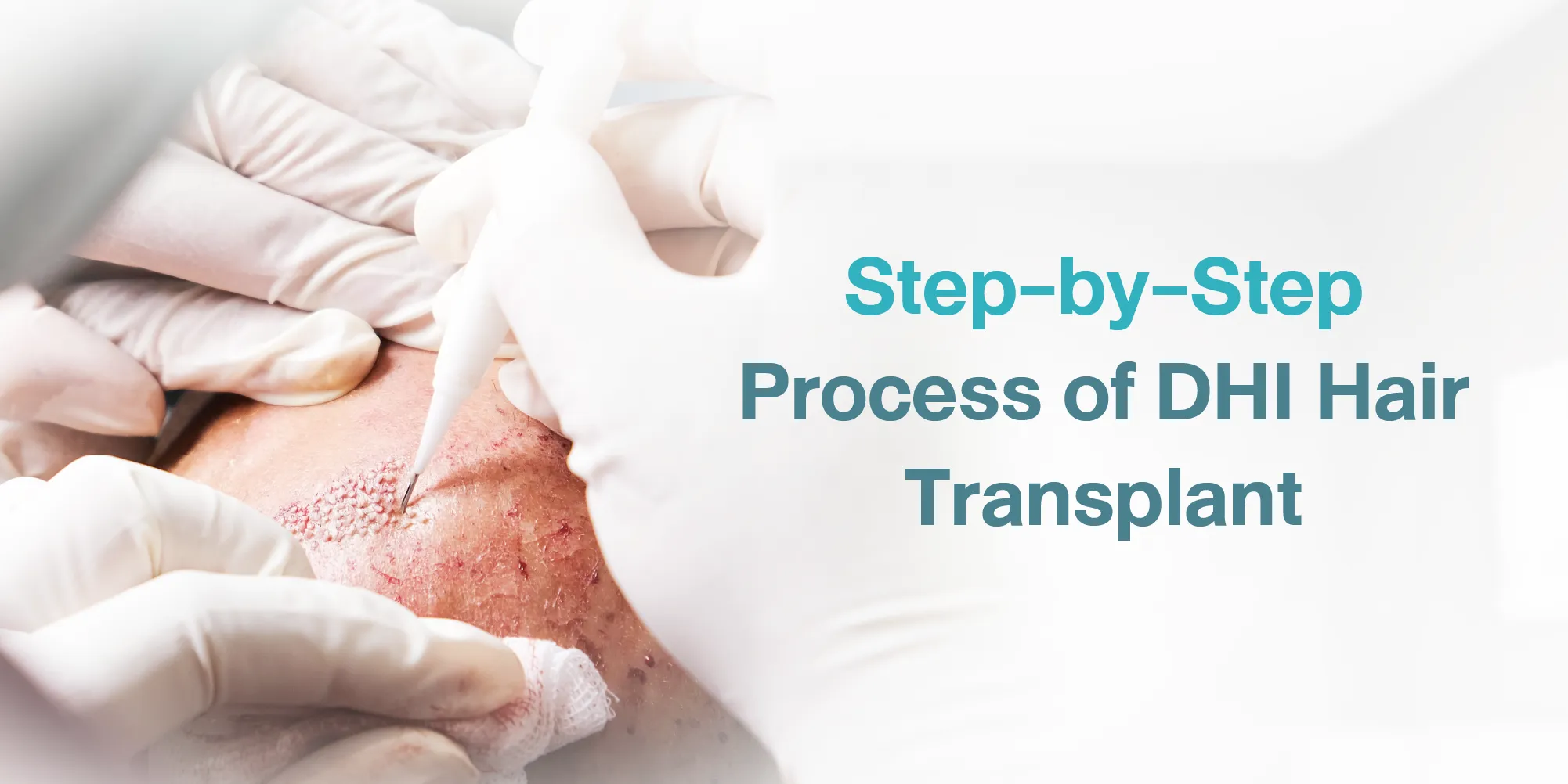 Step-by-Step Process of DHI Hair Transplant