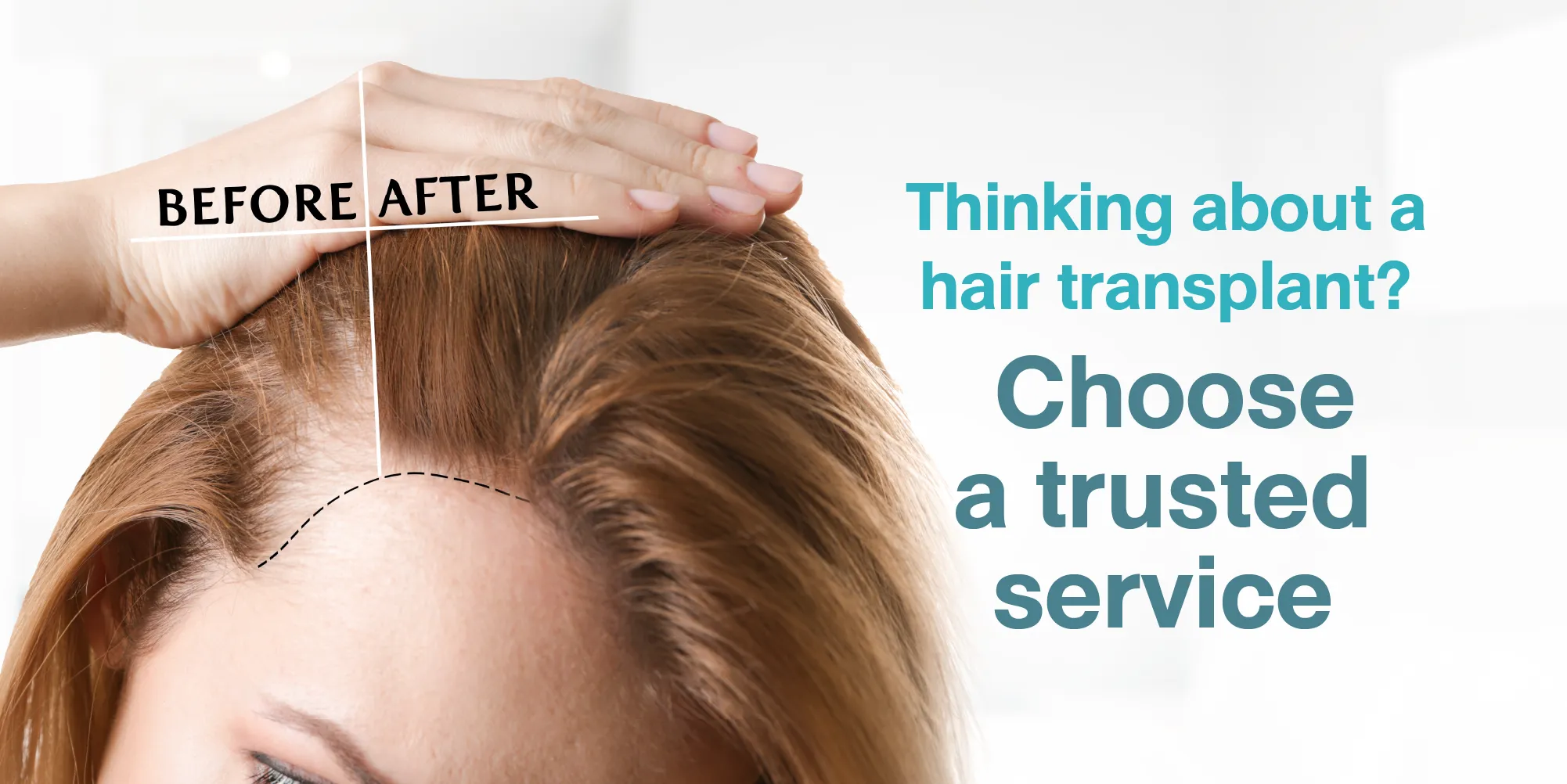 Thinking about hair restoration