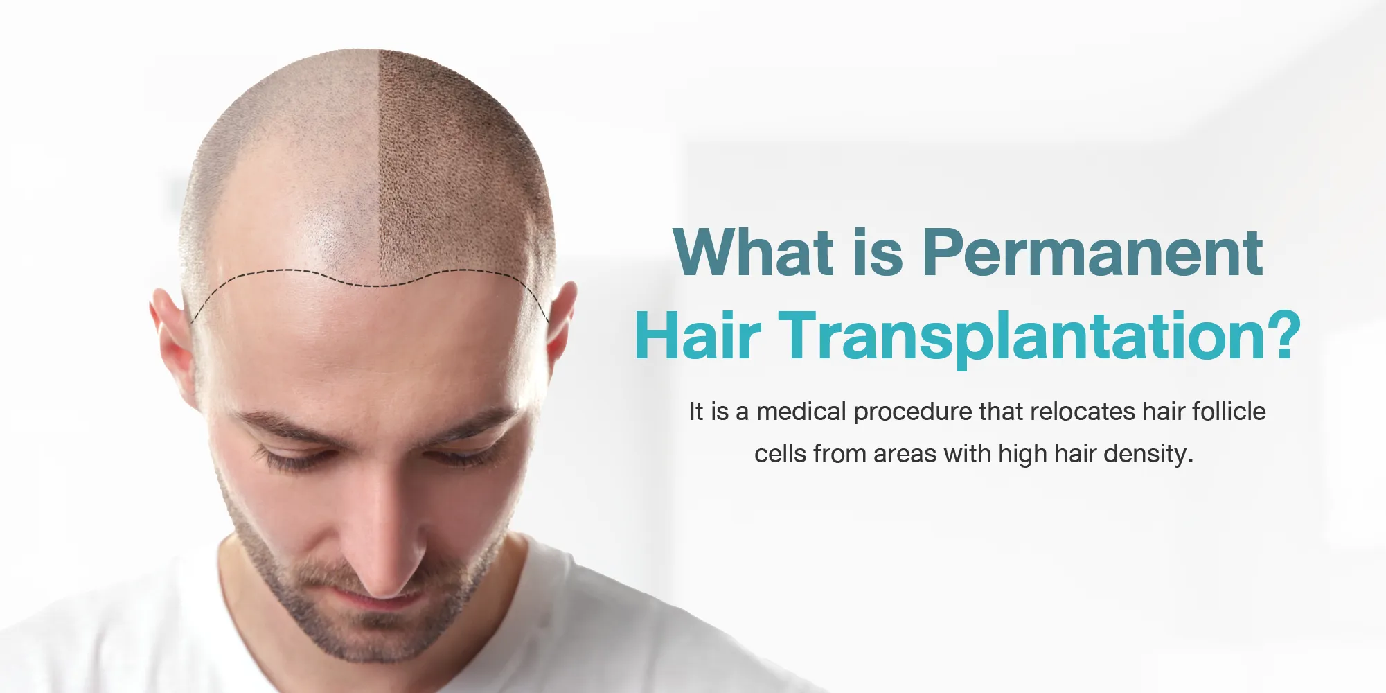 What Is a Permanent Hair Transplant