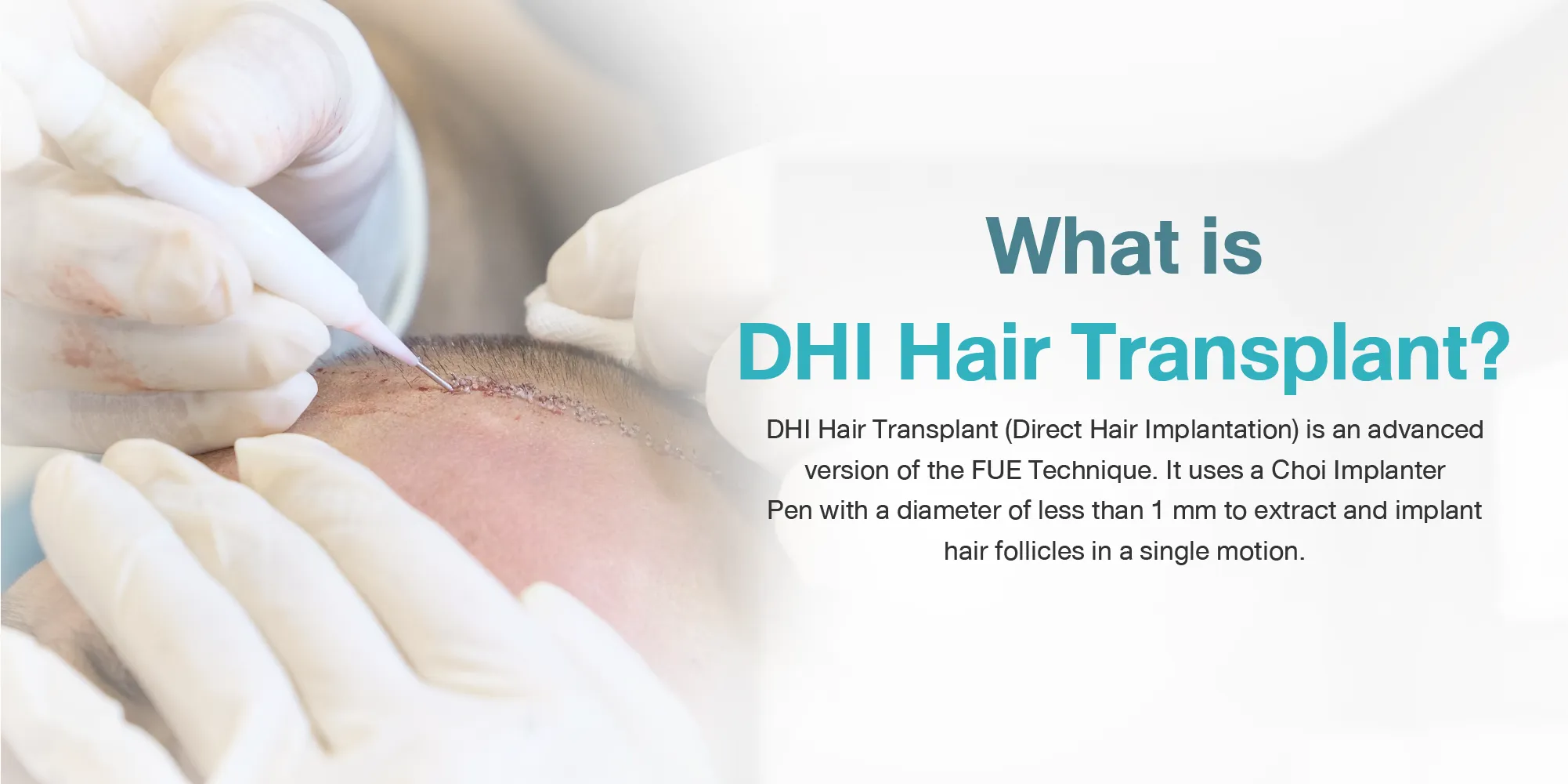 What is DHI Hair Transplant