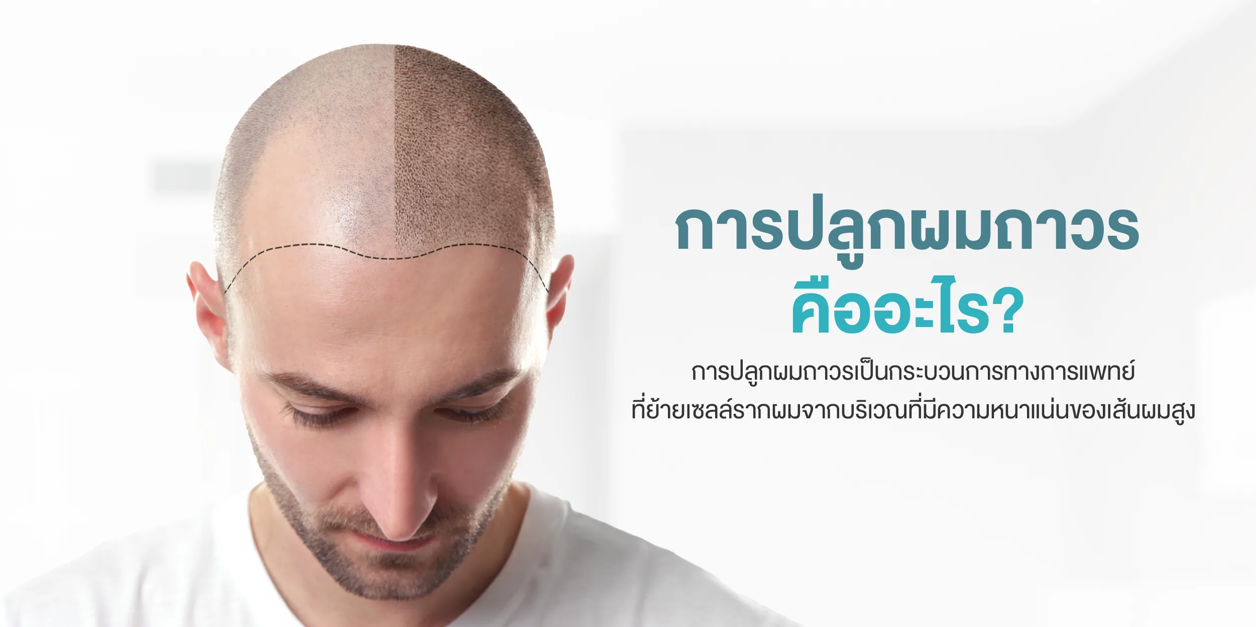 การปลูกผมถาวรคืออะไร