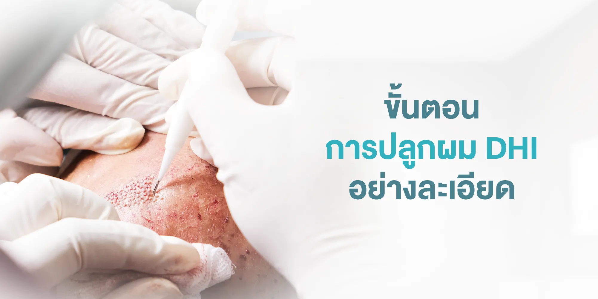 ขั้นตอนการปลูกผม DHI อย่างละเอียด