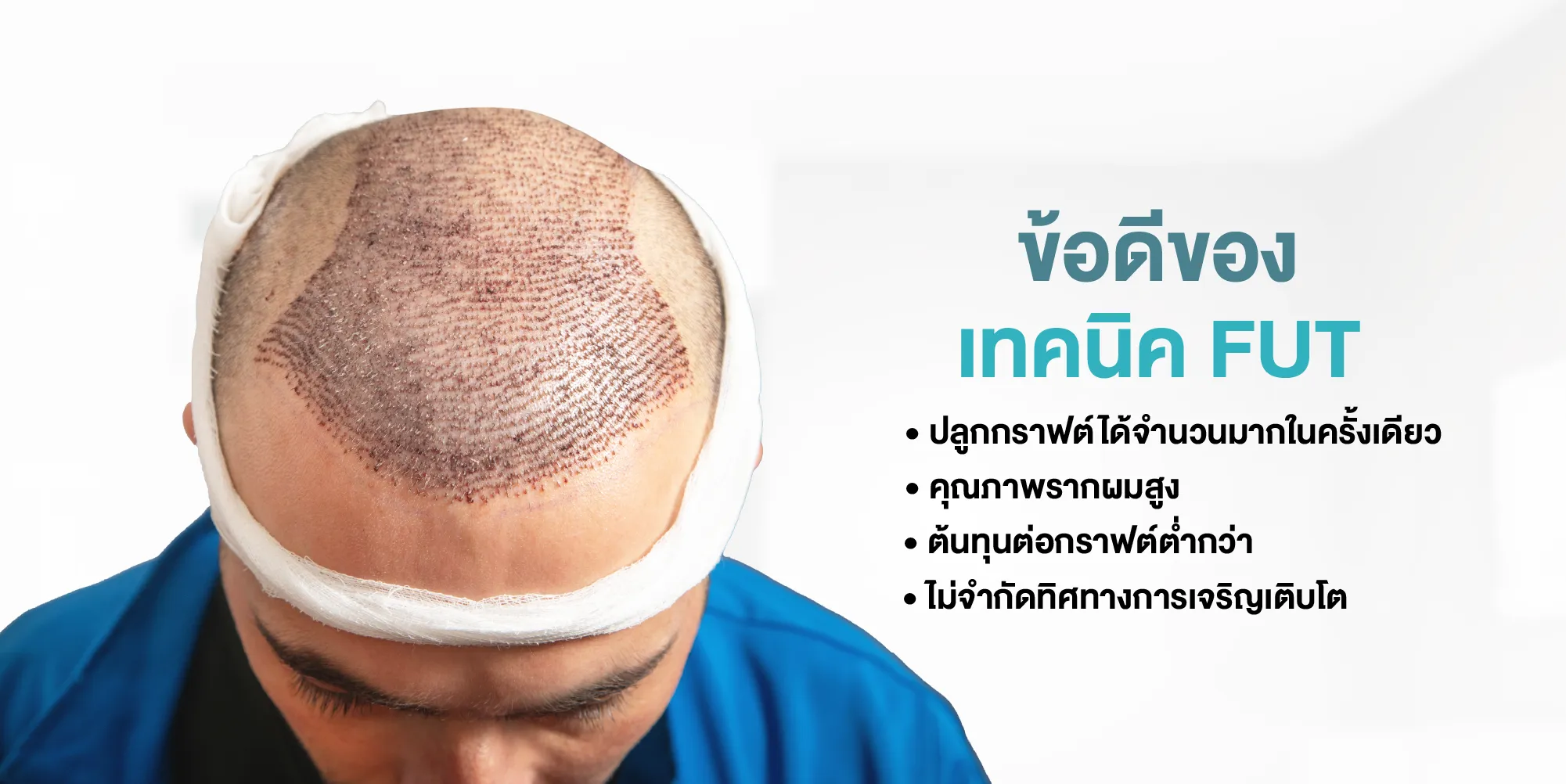 ข้อดีของเทคนิค FUT