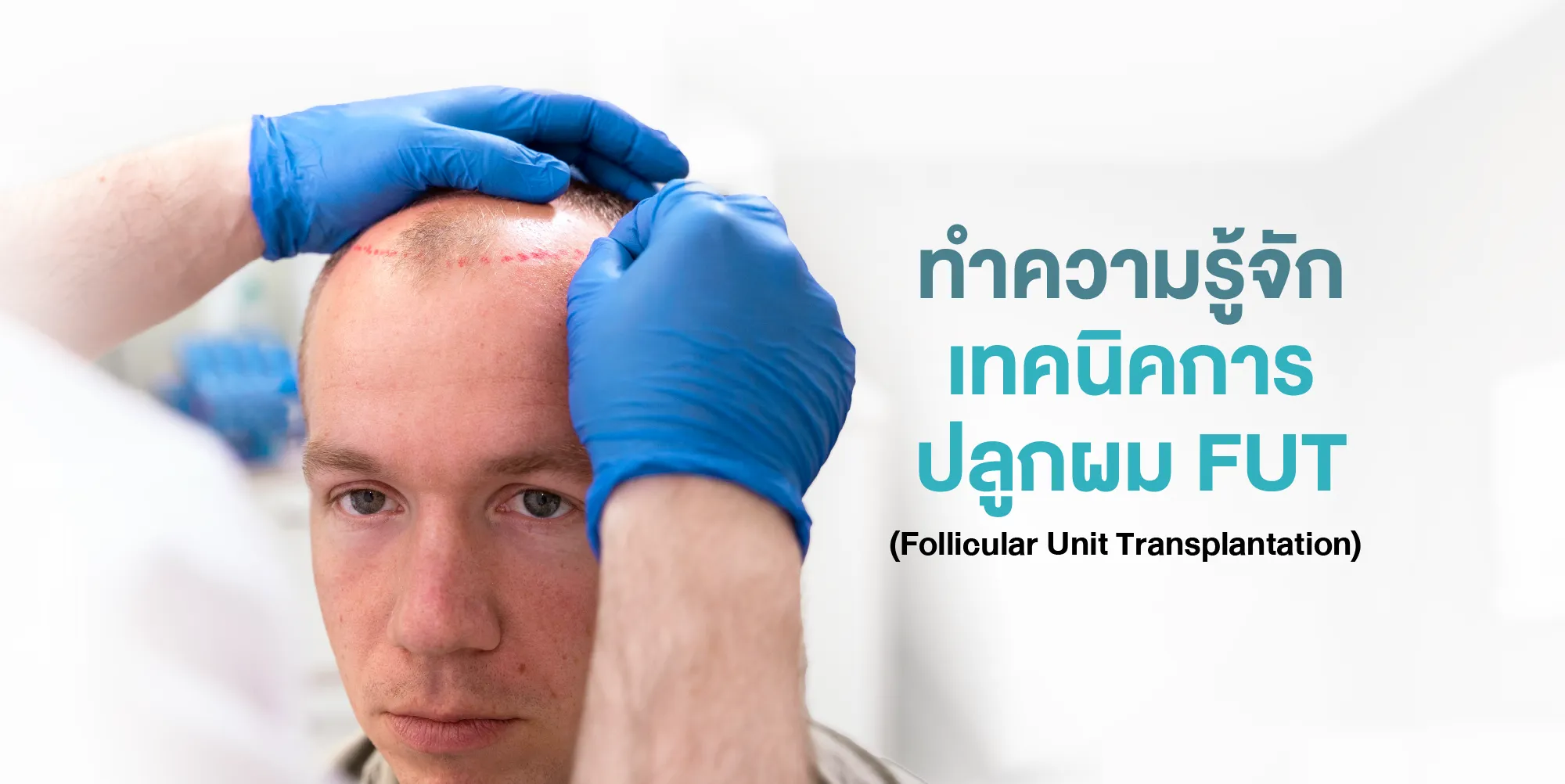 ทำความรู้จักเทคนิคการปลูกผม FUT