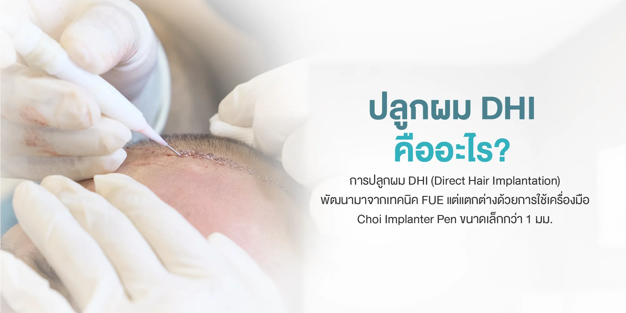 ปลูกผม DHI คืออะไร