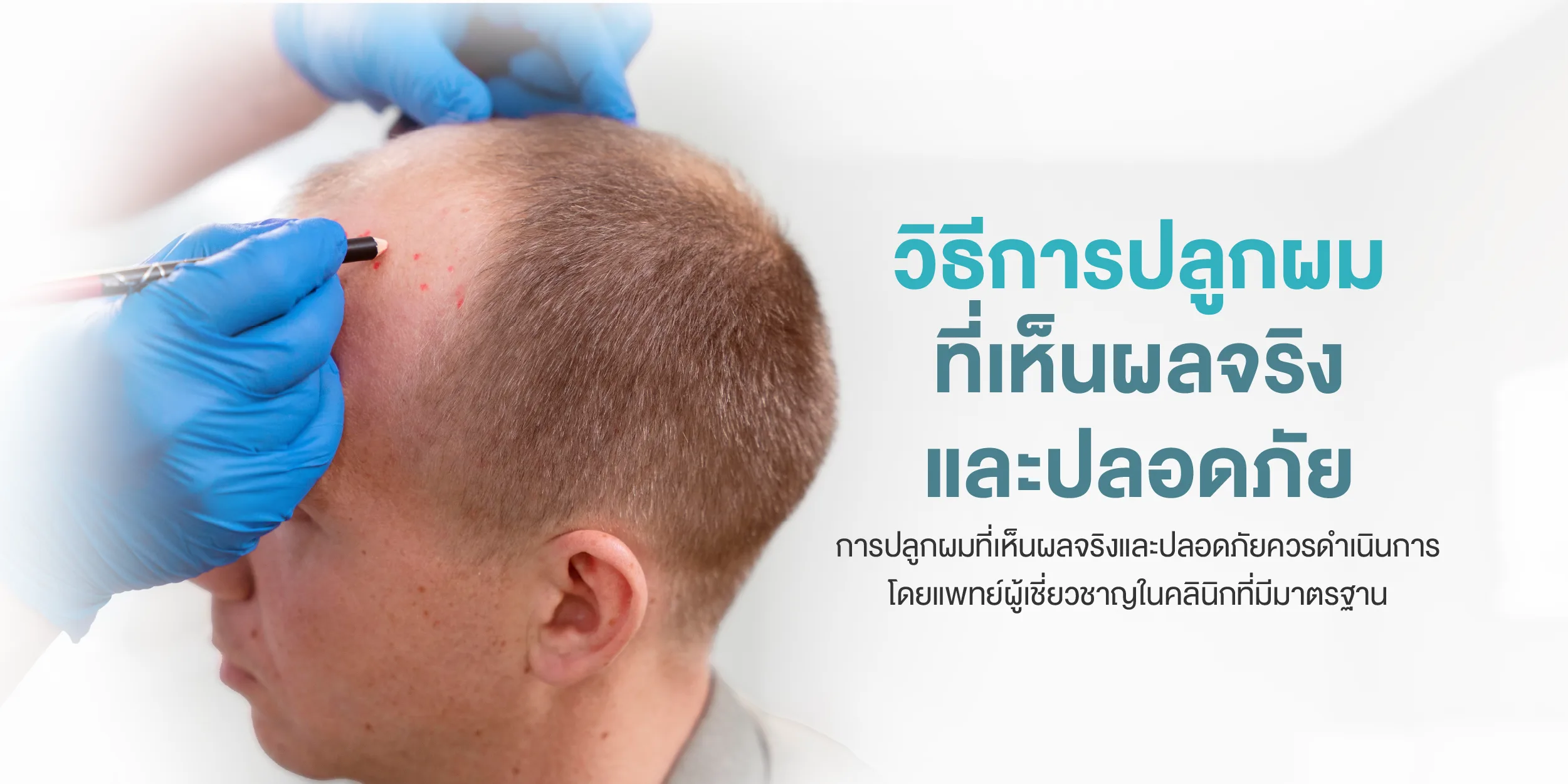 วิธีการปลูกผมที่เห็นผลจริงและปลอดภัย