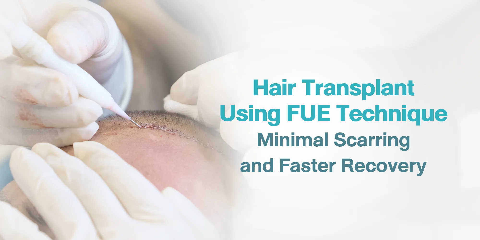 Hair Transplant Using FUE Technique Minimal Scarring and Faster Recovery