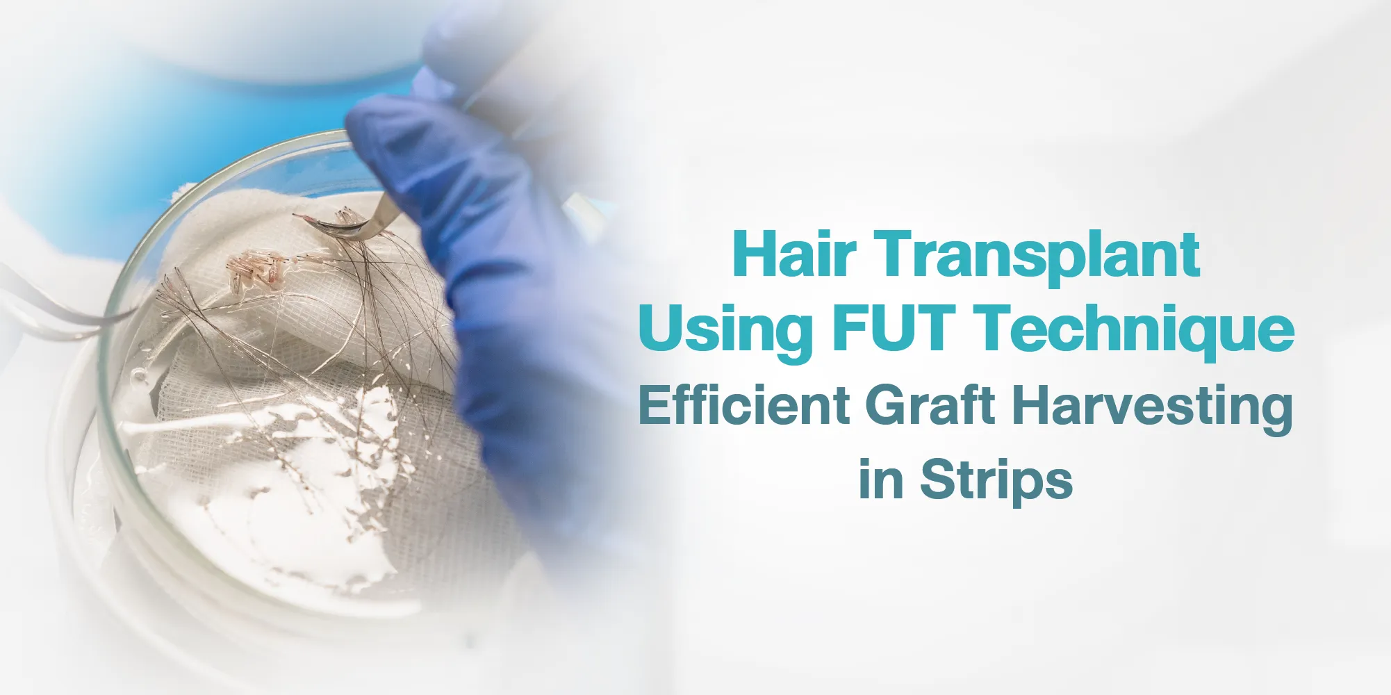 Hair Transplant Using FUT Technique Efficient Graft Harvesting in Strips