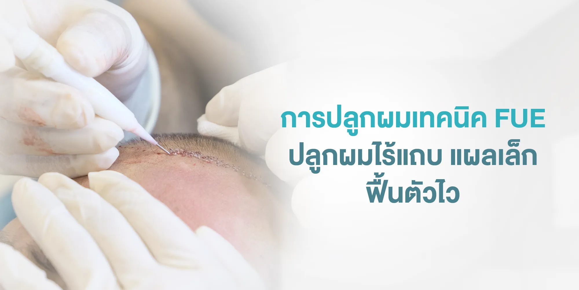 การปลูกผมเทคนิค FUE ปลูกผมไร้แถบ แผลเล็ก ฟื้นตัวไว