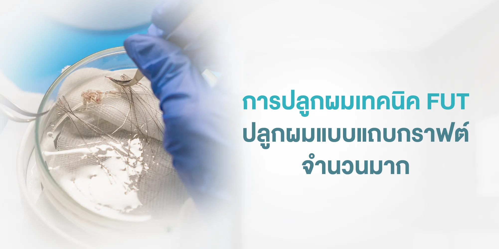 การปลูกผมเทคนิค FUT ปลูกผมแบบแถบกราฟต์จำนวนมาก