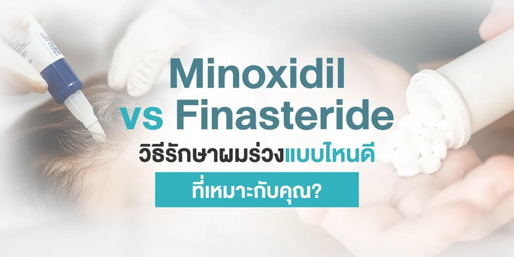 Minoxidil vs Finasteride วิธีรักษาผมร่วงแบบไหนดี ที่เหมาะกับคุณ