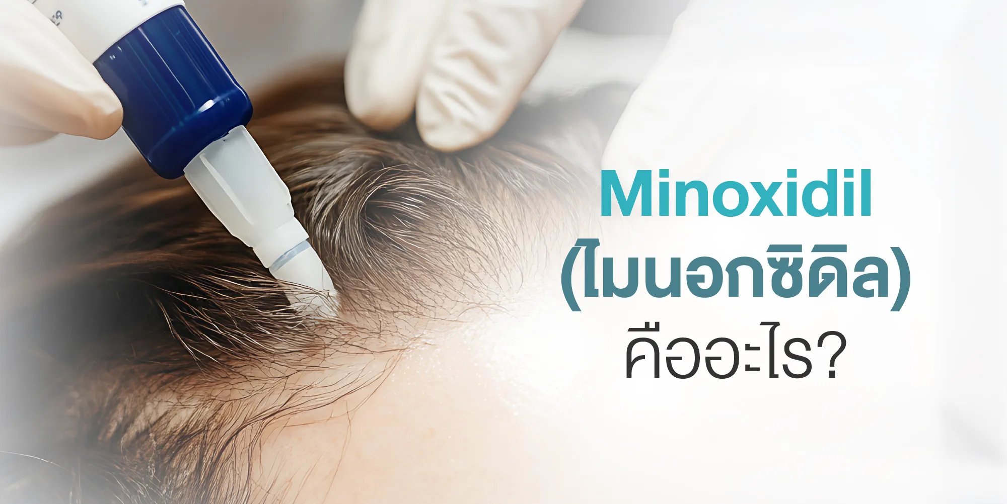 Minoxidil (ไมนอกซิดิล) คืออะไร