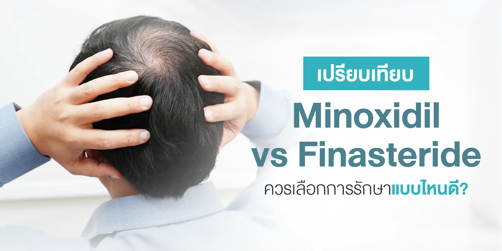 เปรียบเทียบ Minoxidil vs Finasteride ควรเลือกการรักษาแบบไหนดี