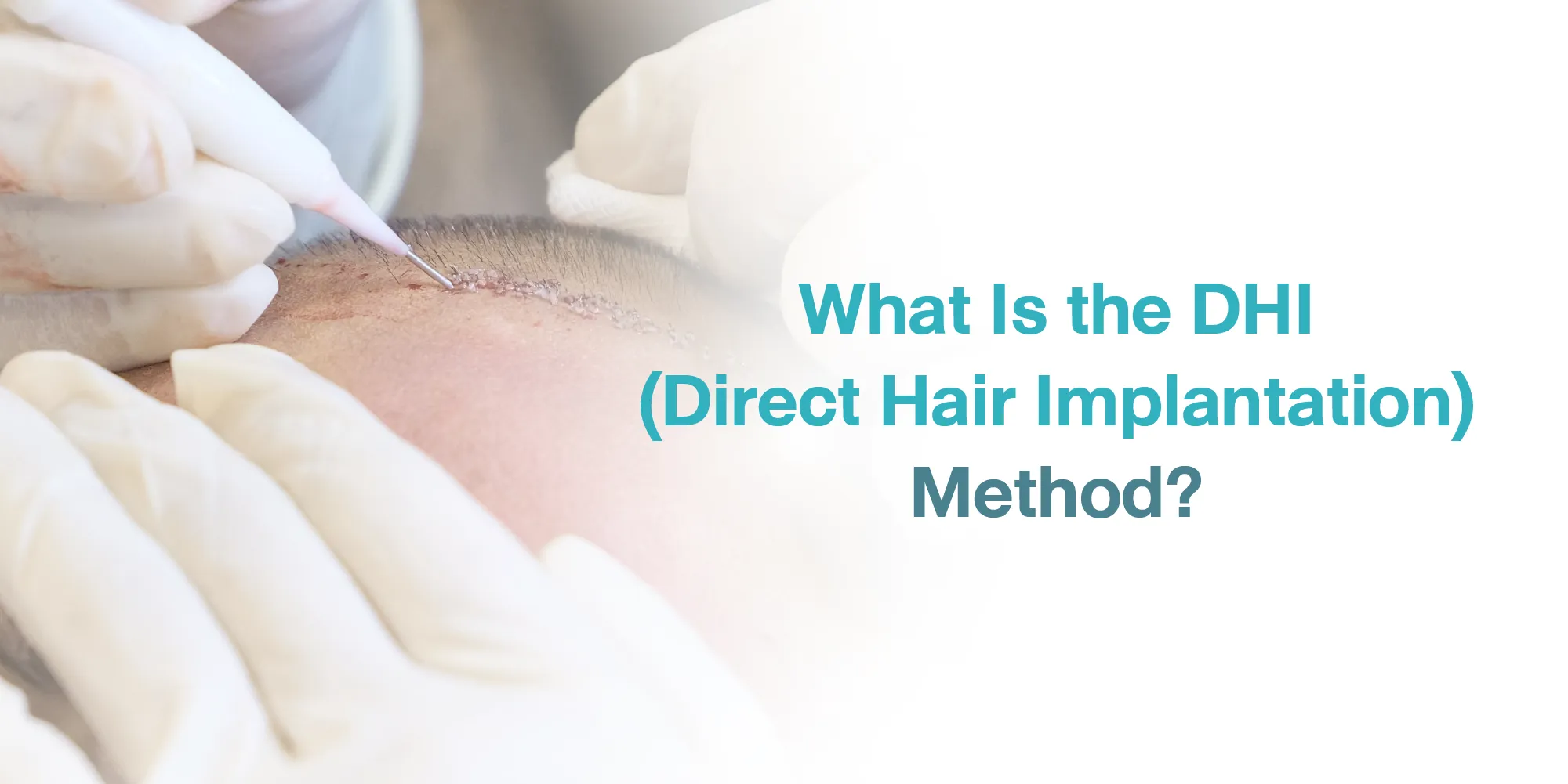 What Is the DHI (Direct Hair Implantation) Method