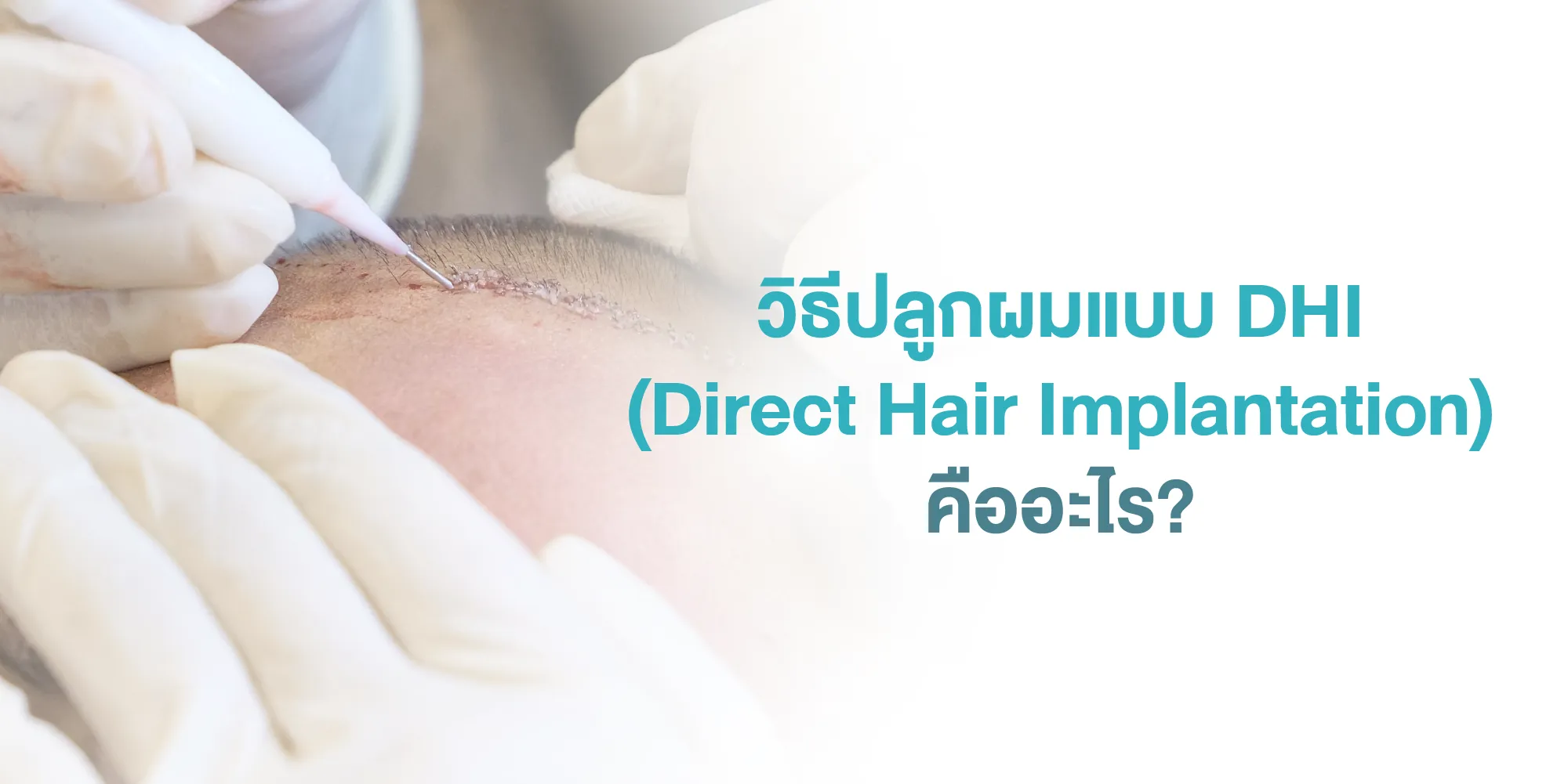 วิธีปลูกผมแบบ DHI (Direct Hair Implantation) คืออะไร