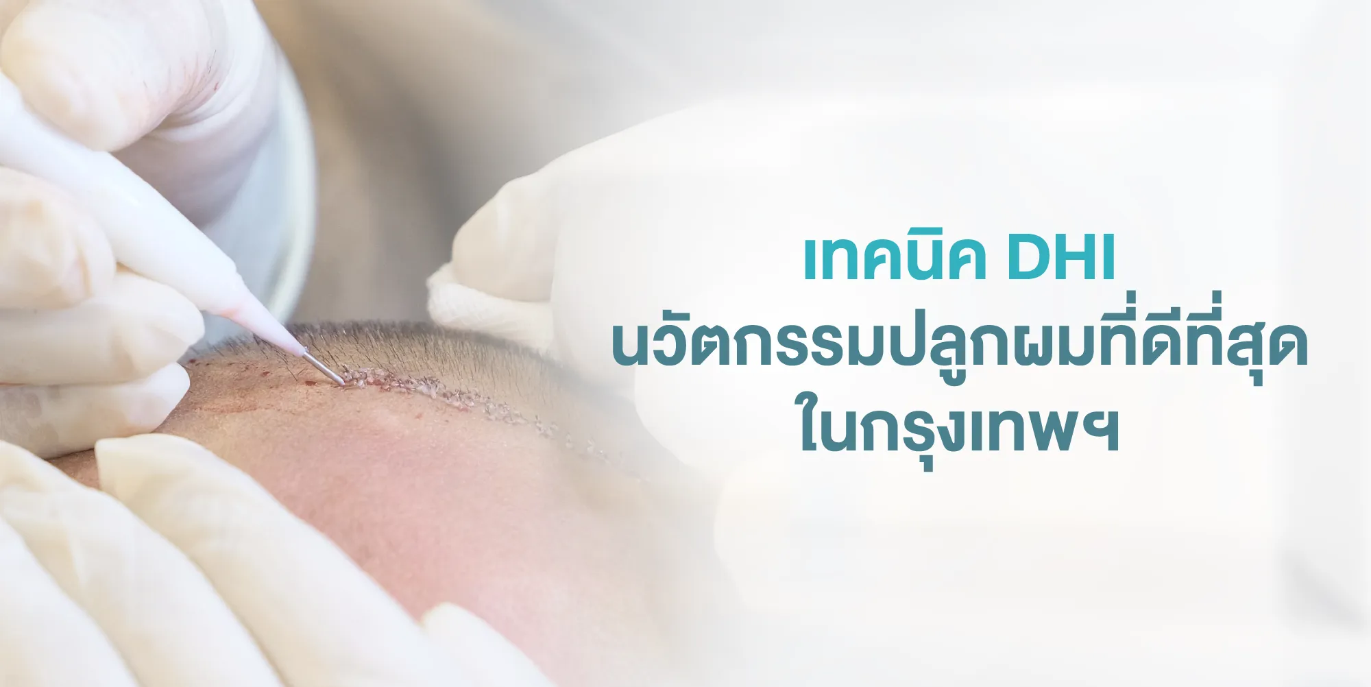 เทคนิค DHI นวัตกรรมปลูกผมที่ดีที่สุดในกรุงเทพฯ