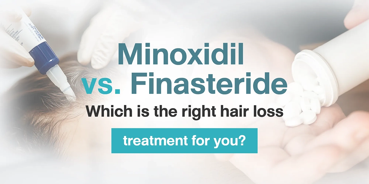 ​​Minoxidil vs. Finasteride Which is the right hair loss treatment for you