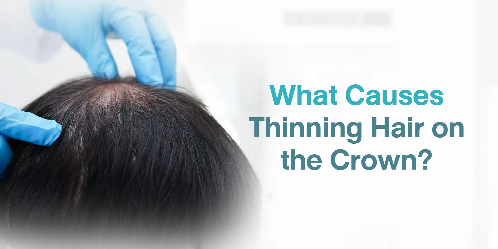 What Causes Thinning Hair on the Crown