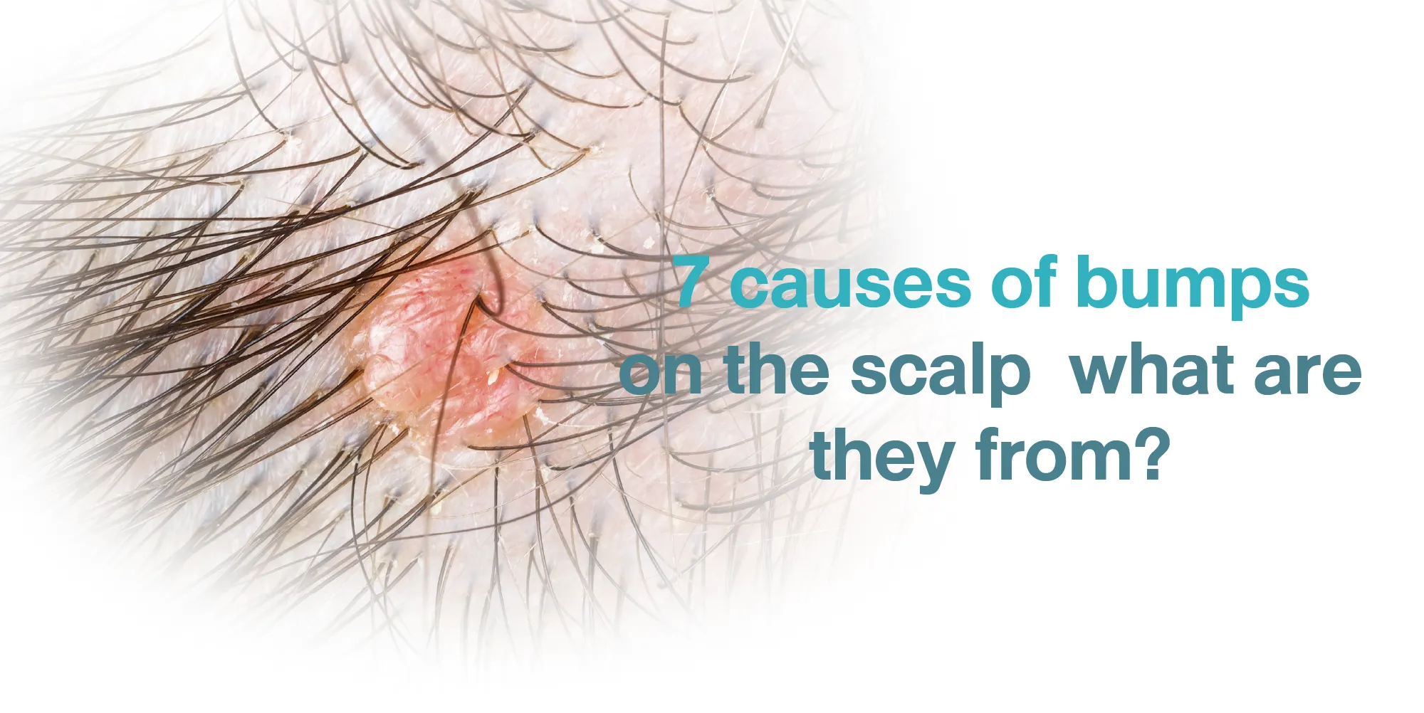 7 causes of bumps on the scalp what are they from