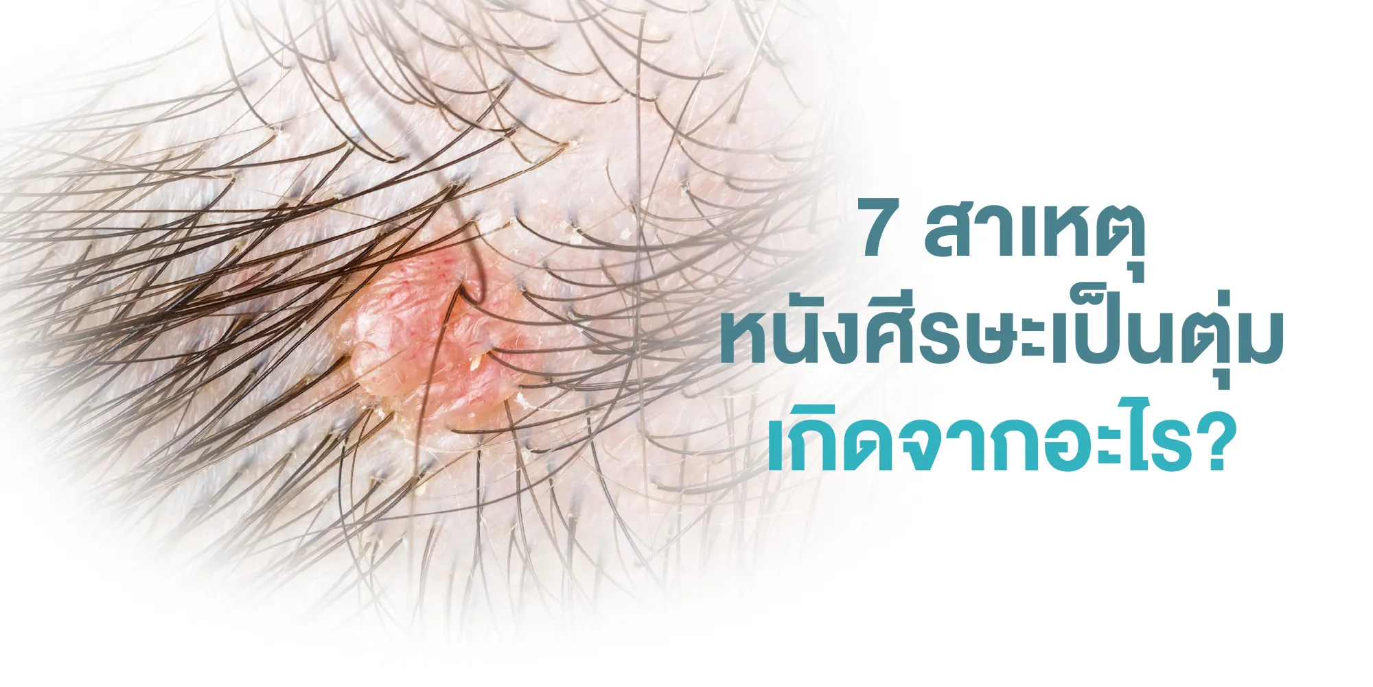 7 สาเหตุหนังศีรษะ เป็นตุ่มเกิดจากอะไร