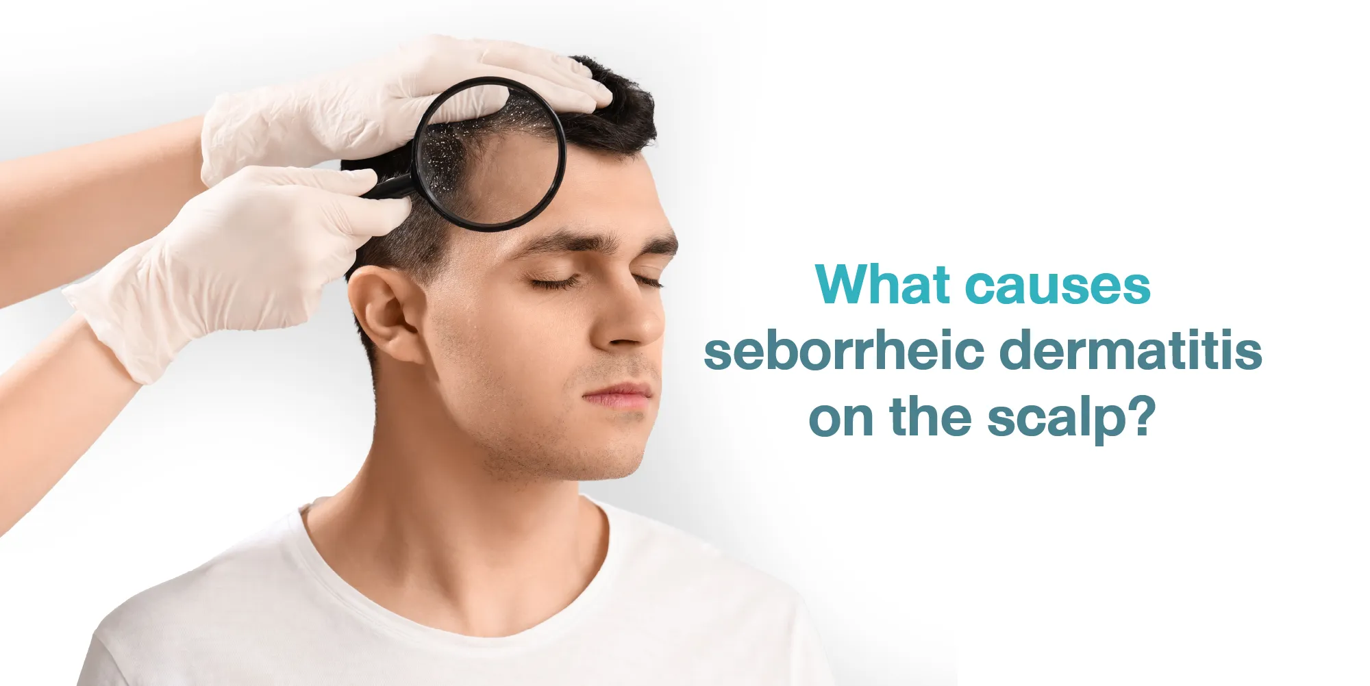 What causes seborrheic dermatitis on the scalp