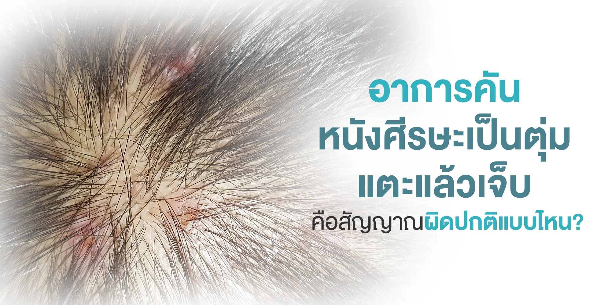 อาการคันหนังศีรษะ เป็นตุ่ม แตะแล้วเจ็บ คือสัญญาณผิดปกติแบบไหน