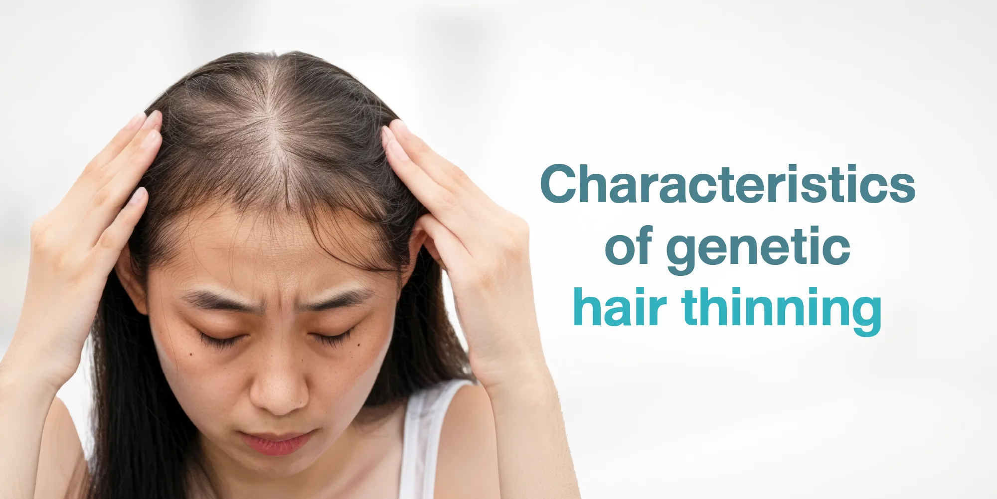 Characteristics of genetic hair thinning