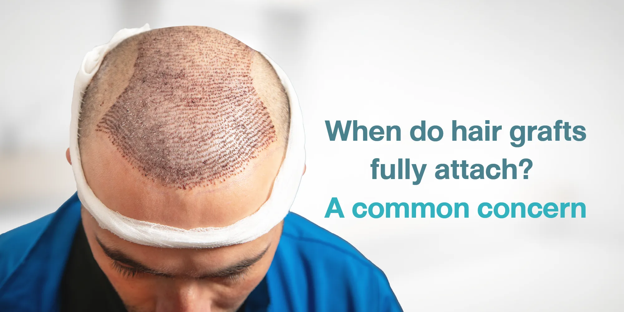 When do hair grafts fully attach A common concern