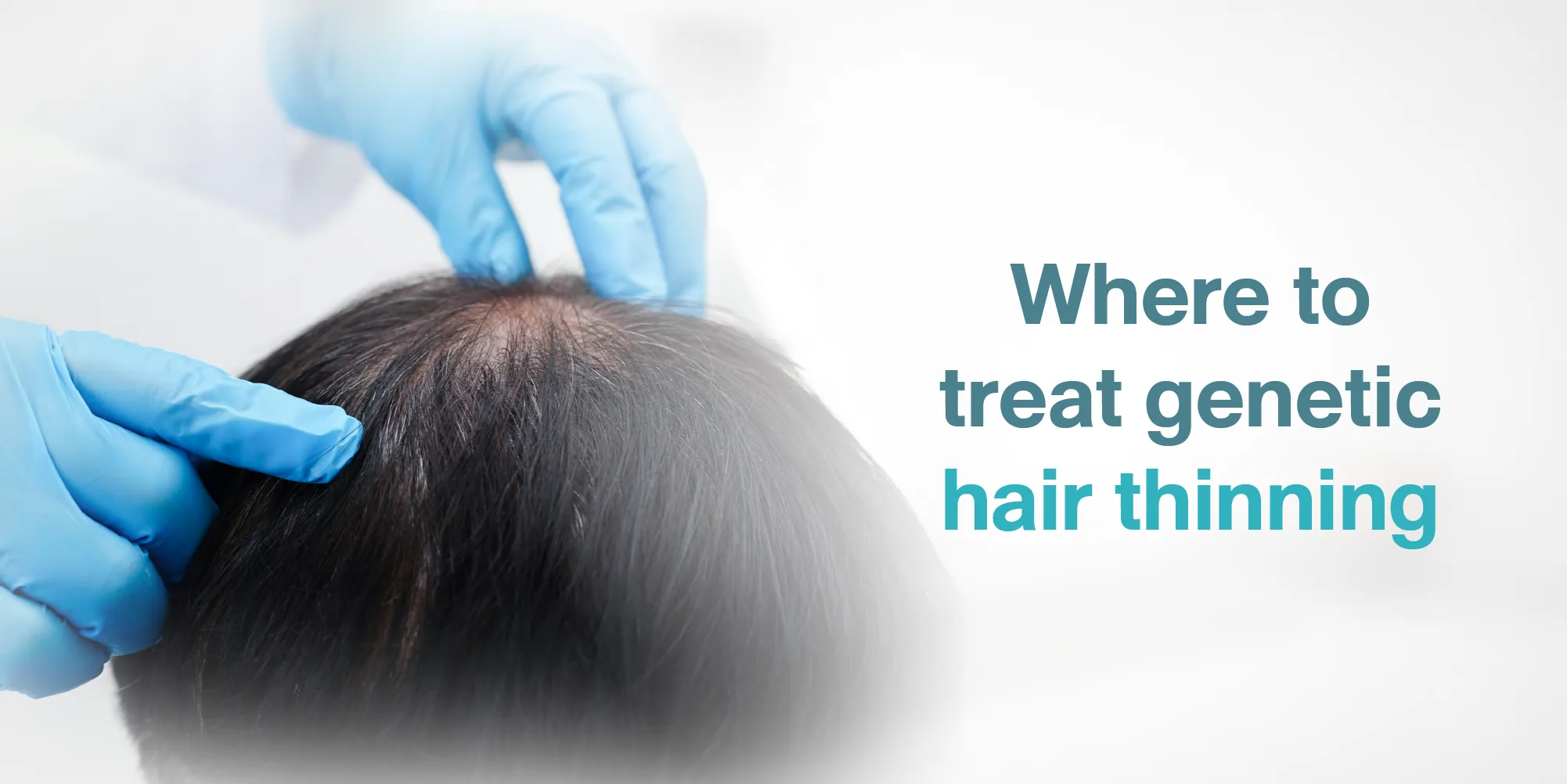 Where to treat genetic hair thinning