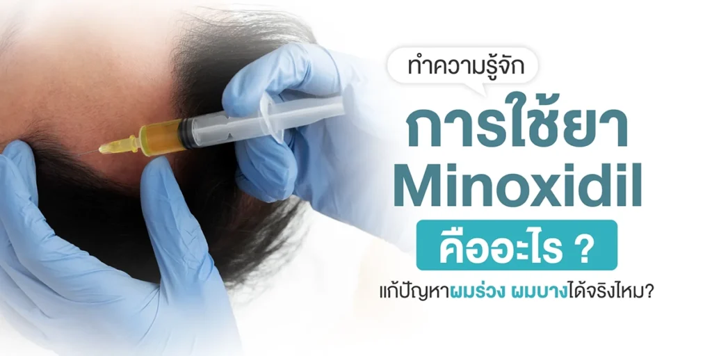 ทำความรู้จักการใช้ยา Minoxidil คืออะไร