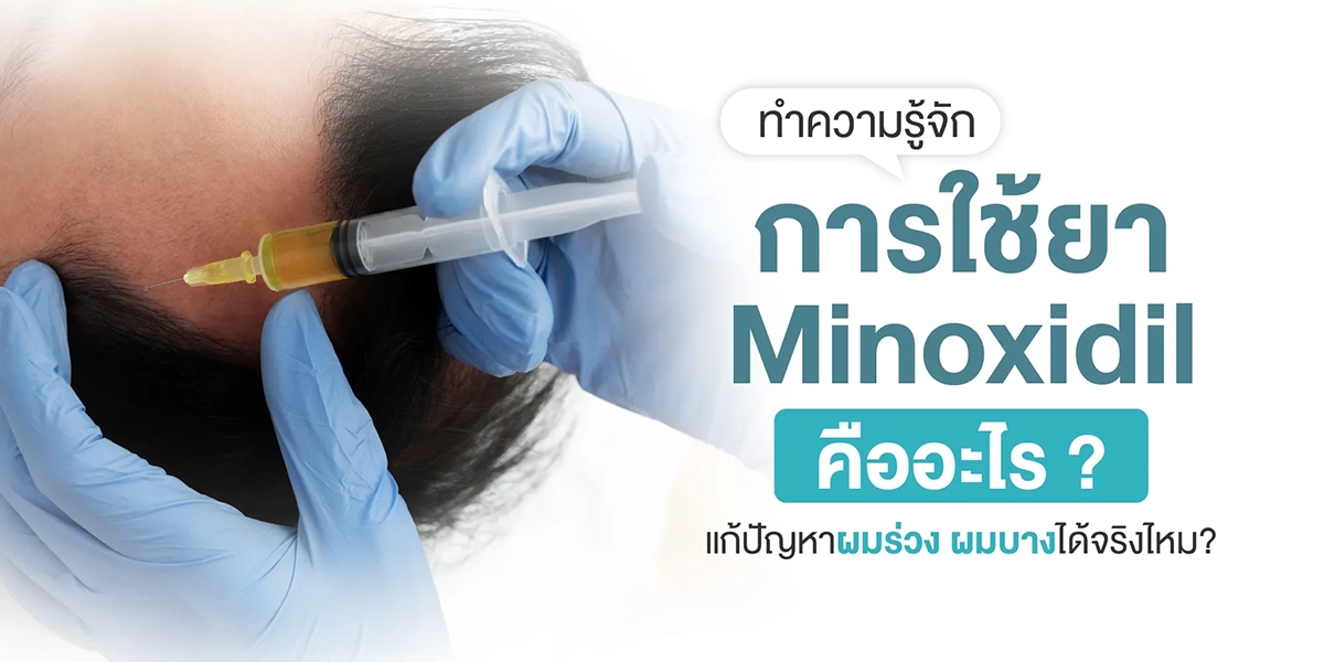 ทำความรู้จักการใช้ยา Minoxidil คืออะไร
