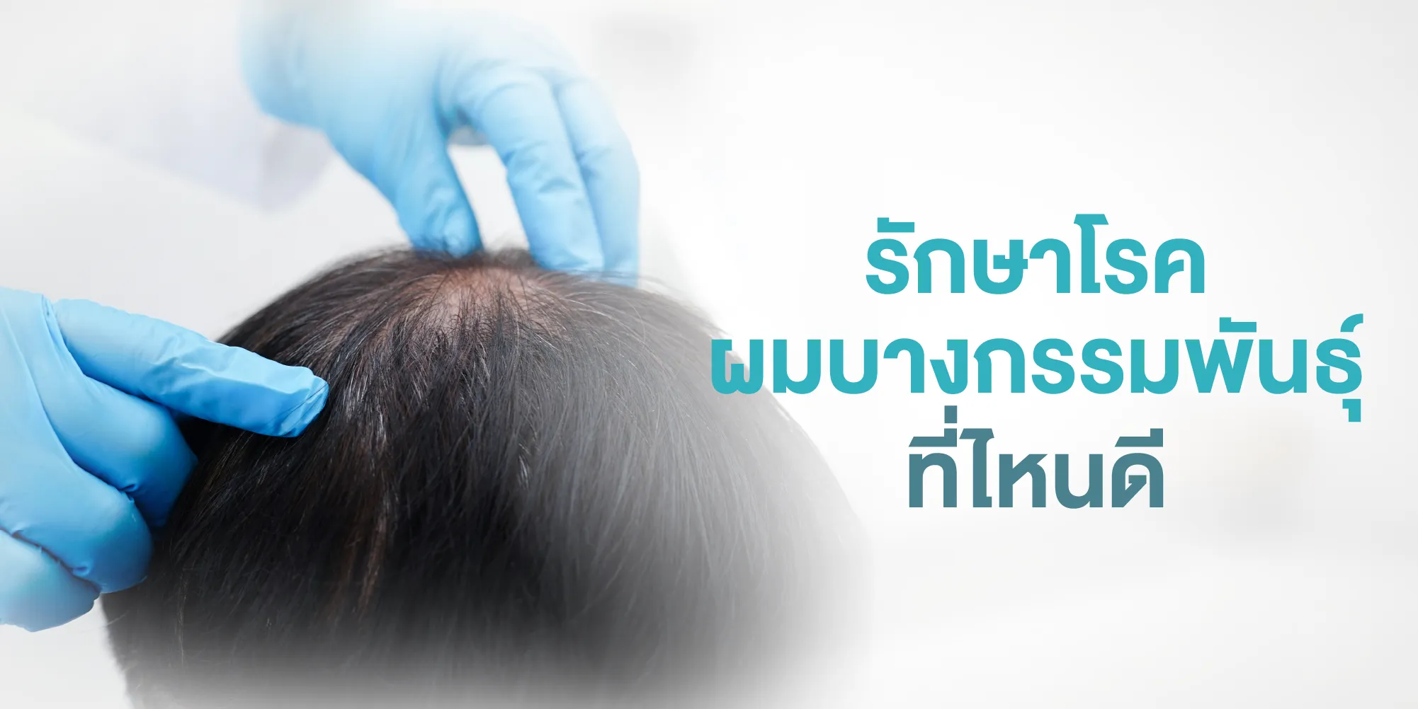รักษาโรคผมบางกรรมพันธุ์ที่ไหนดี