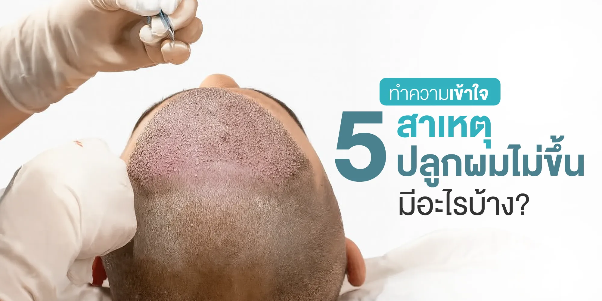 ทำความเข้าใจ 5 สาเหตุปลูกผมไม่ขึ้น มีอะไรบ้าง