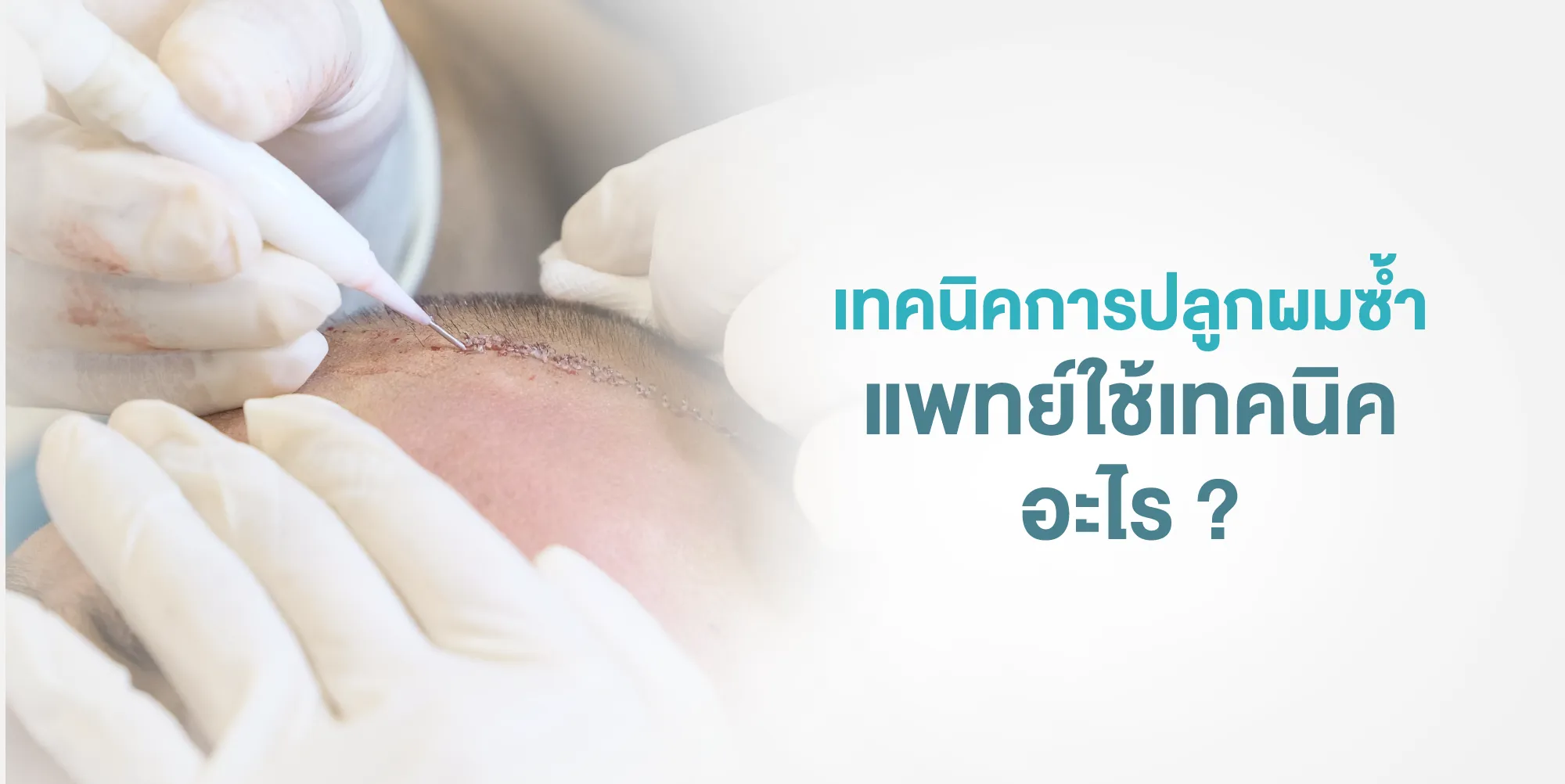 เทคนิคการปลูกผมซ้ำแพทย์ใช้เทคนิคอะไร