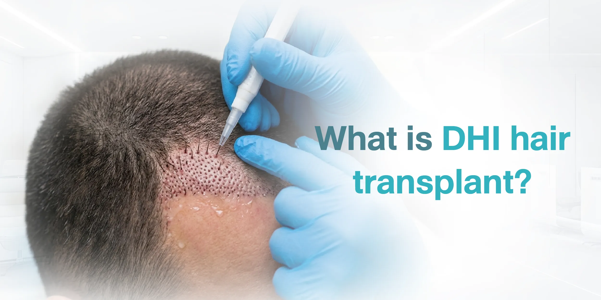 What is DHI hair transplant
