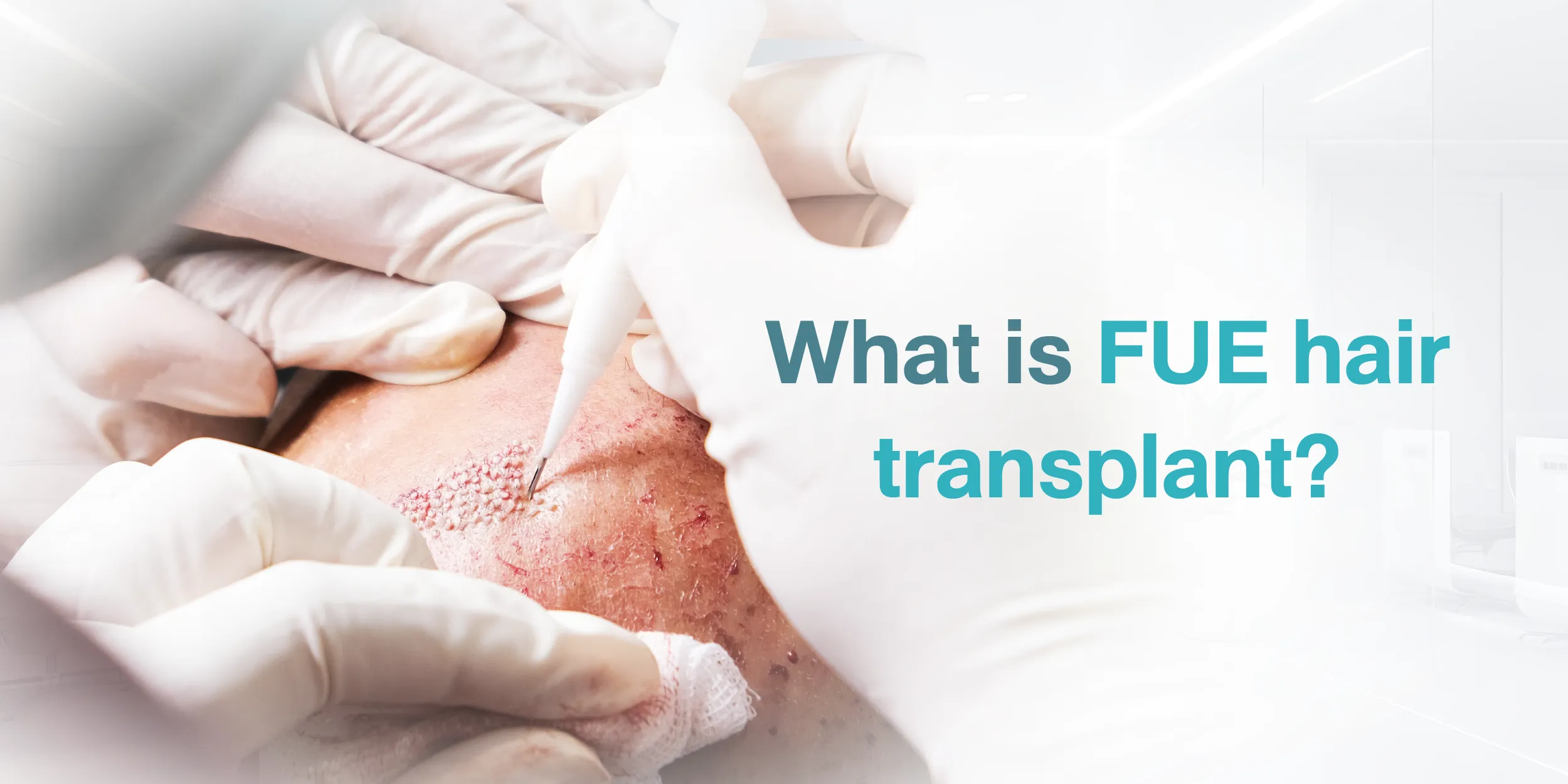 What is FUE hair transplant