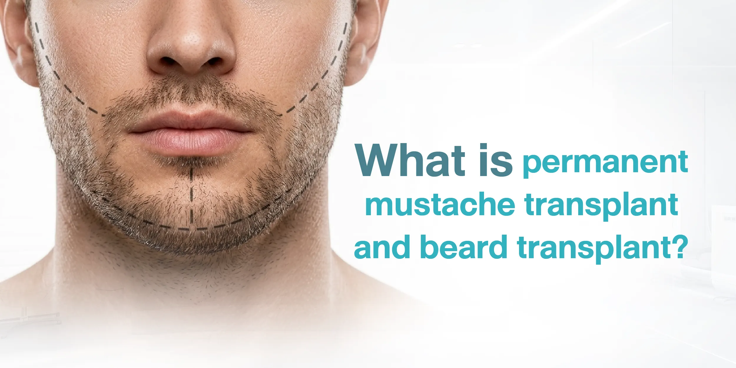 What is permanent mustache transplant and beard transplant