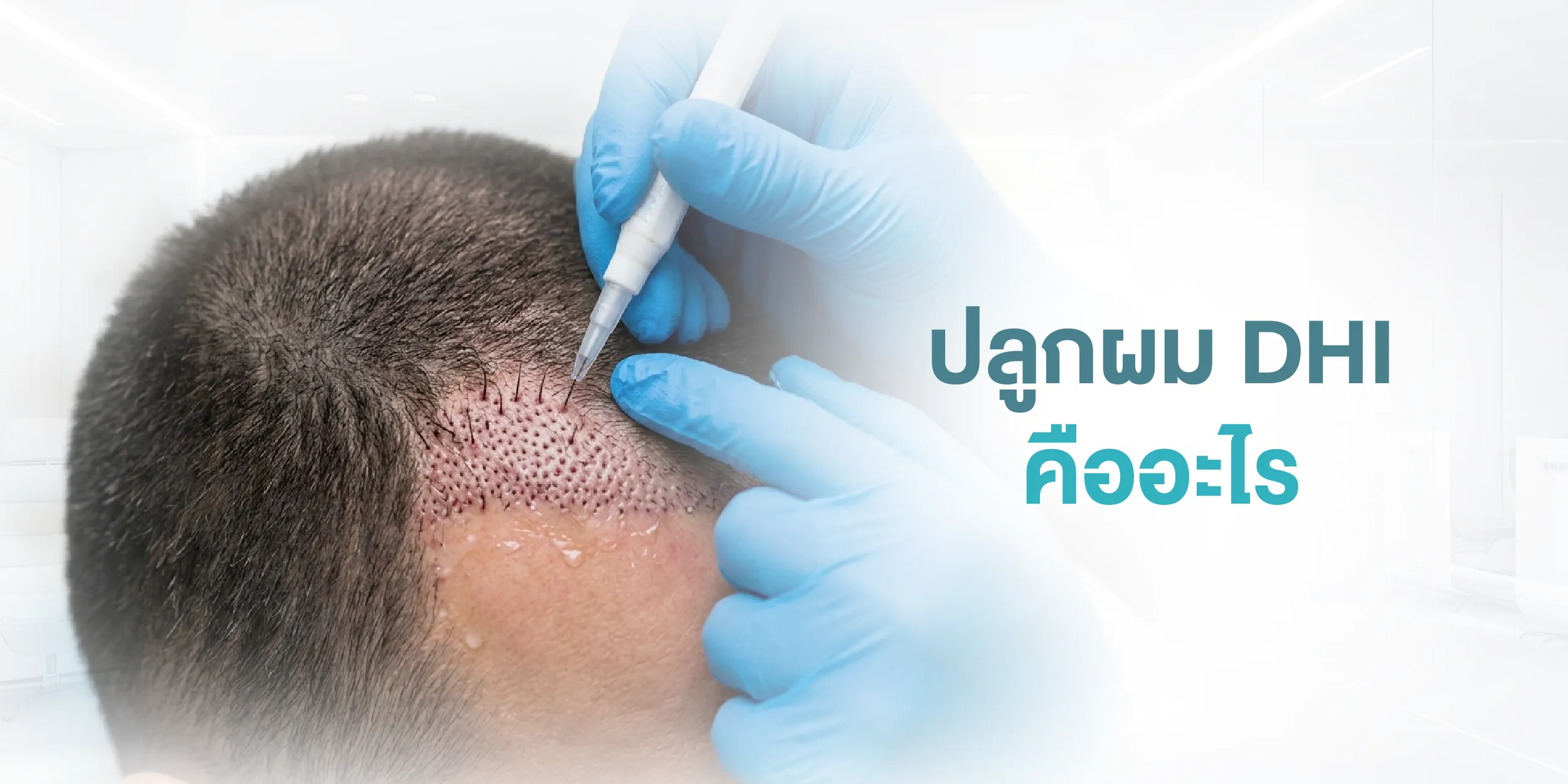 ปลูกผม DHI คืออะไร