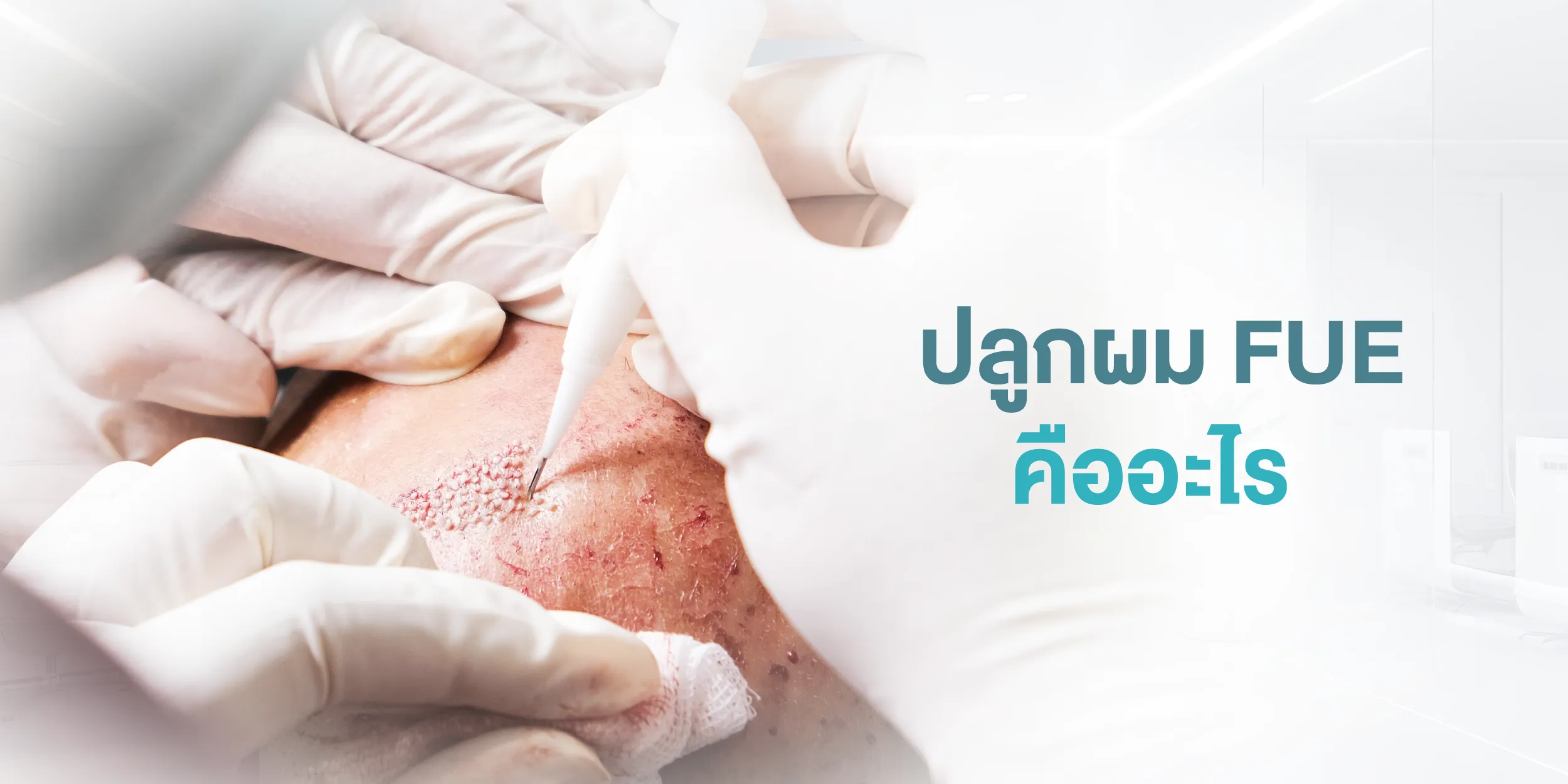 ปลูกผม FUE คืออะไร