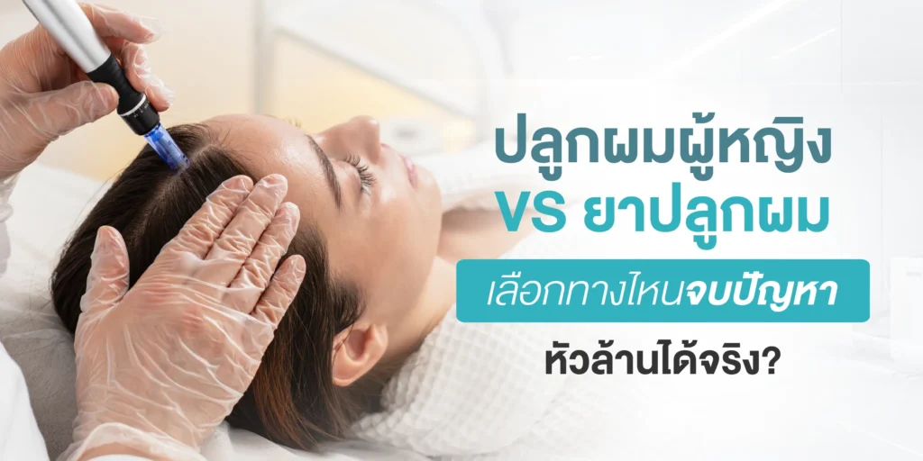 ปลูกผมผู้หญิง VS ยาปลูกผม เลือกทางไหนจบปัญหาหัวล้านได้จริง