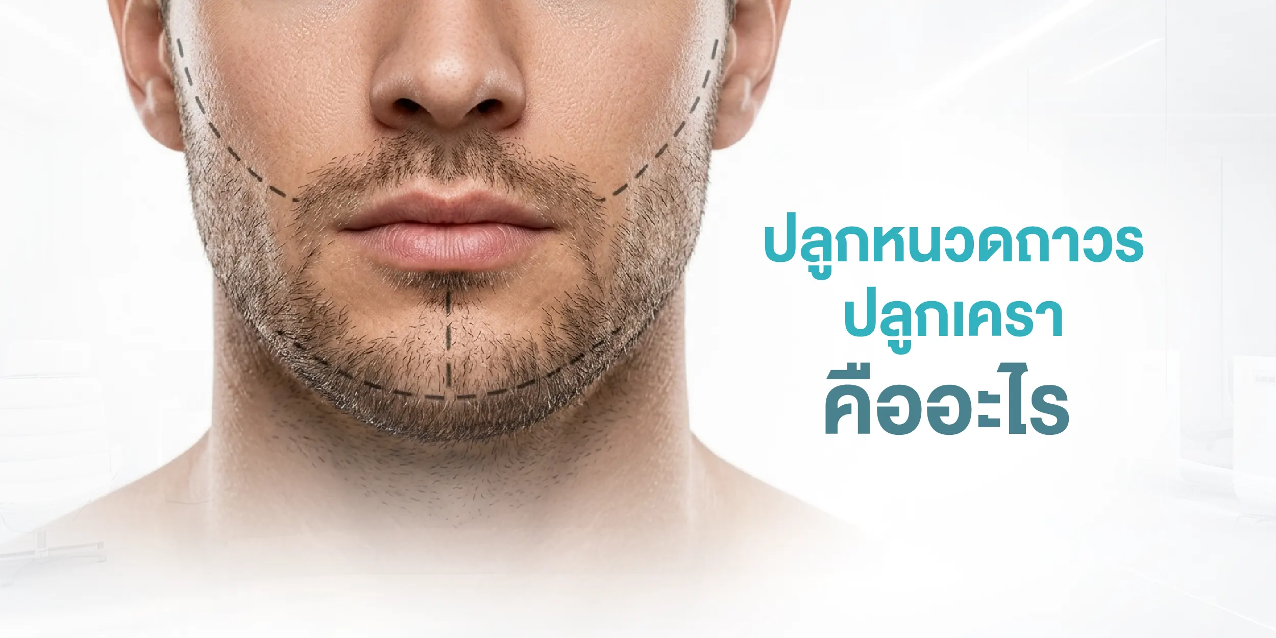 ปลูกหนวดถาวร ปลูกเครา คืออะไร
