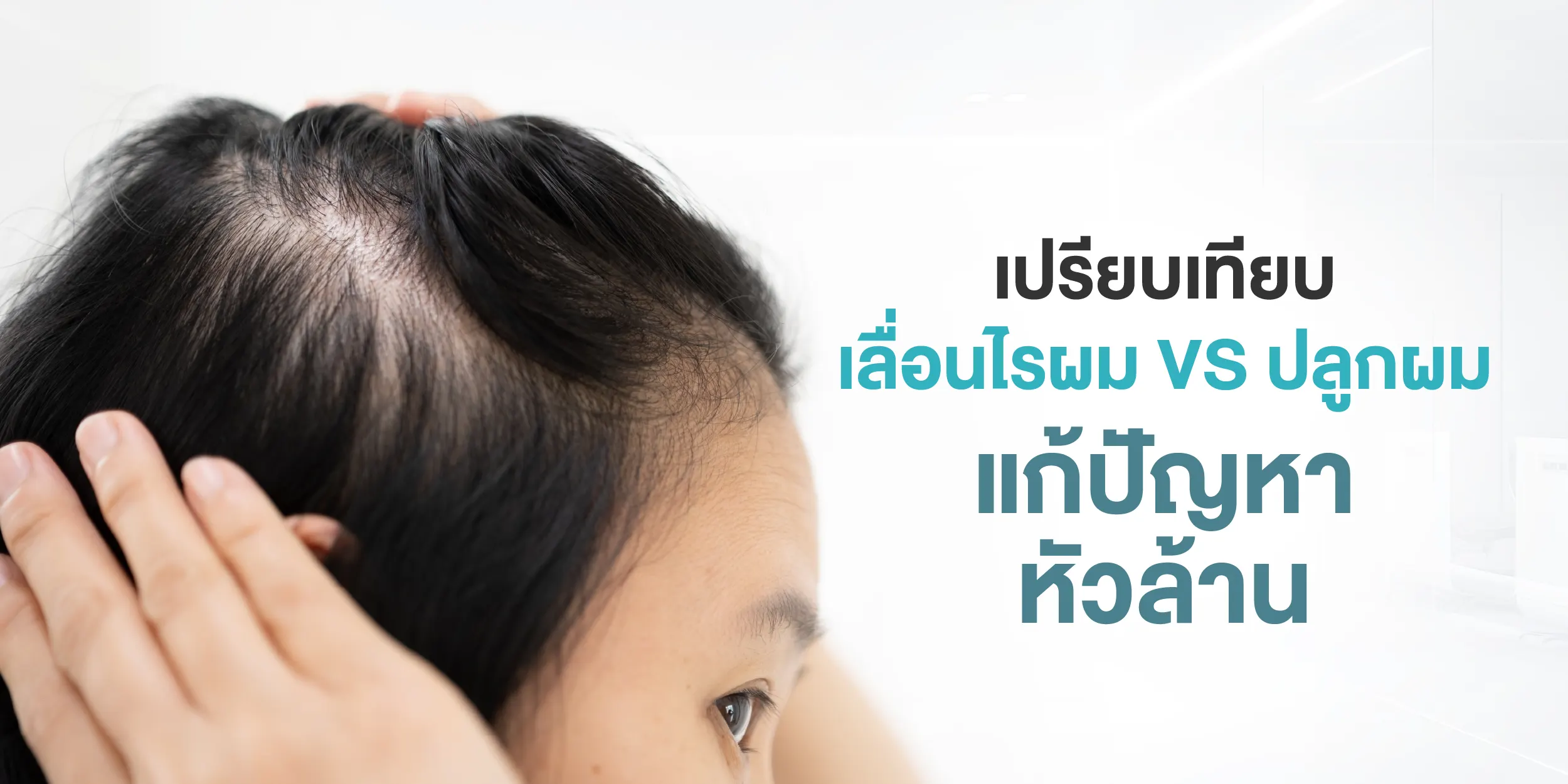 เปรียบเทียบ เลื่อนไรผม VS ปลูกผม แก้ปัญหาหัวล้าน
