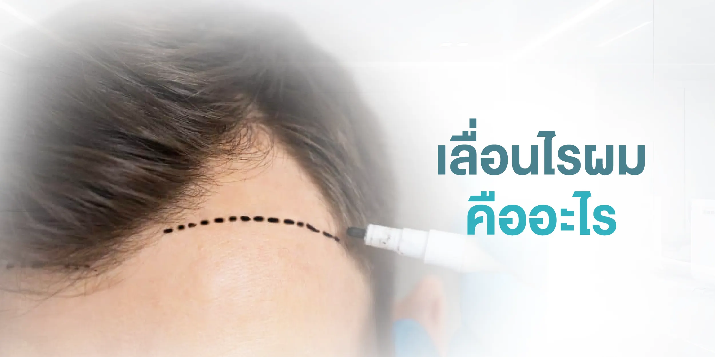เลื่อนไรผม คืออะไร